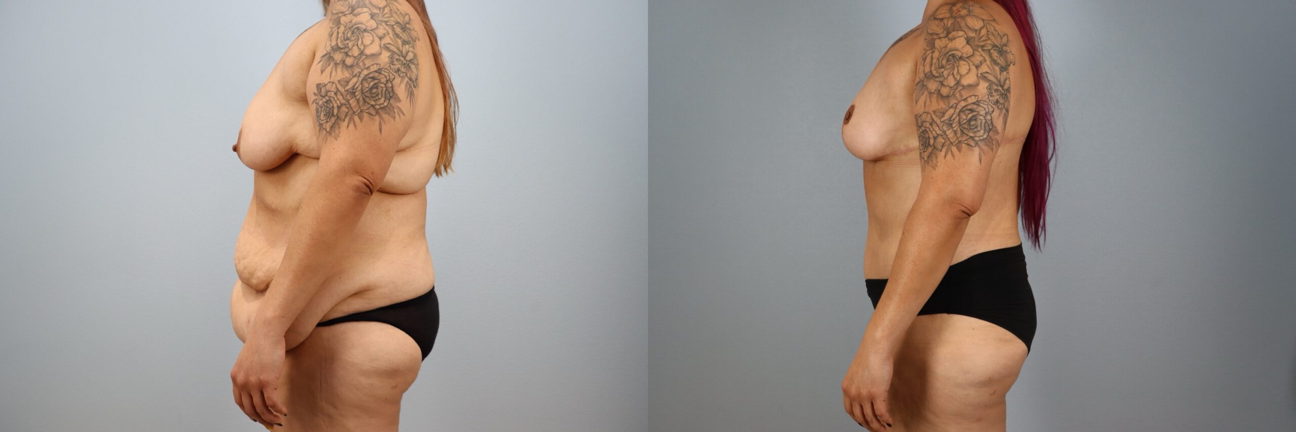 Before and after – Mommy Makeover – Female patient, age 40-49 – Image 42