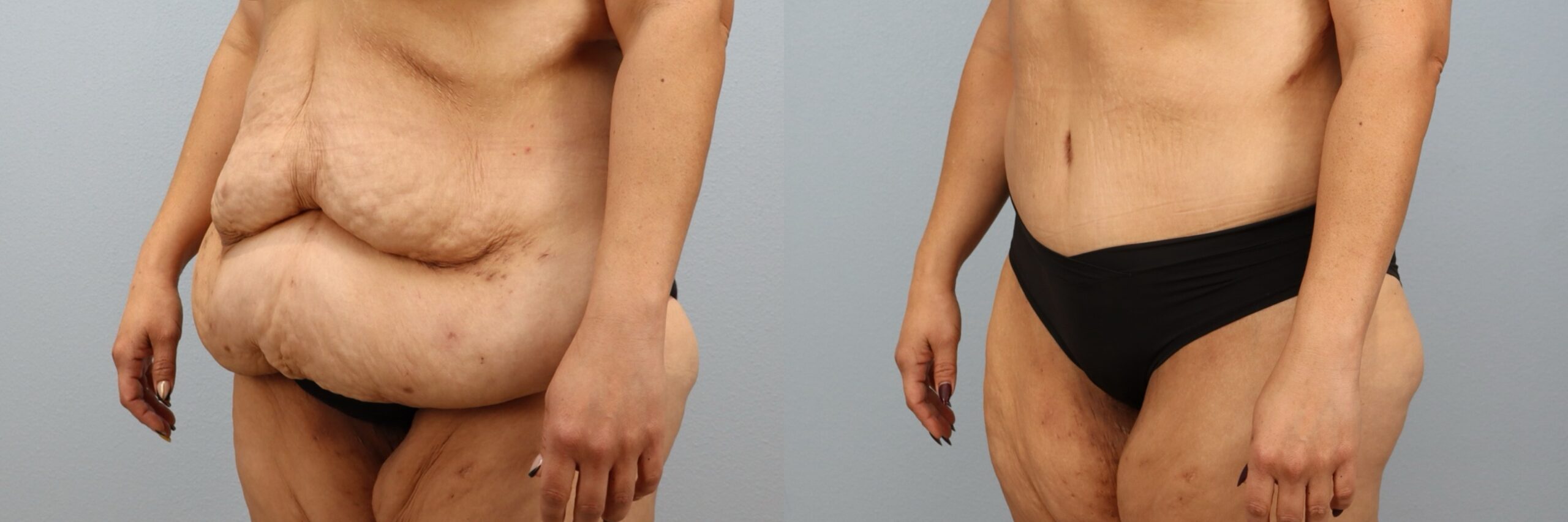 Before and after – Tummy Tuck – Female patient, age 40-49 – Image 17