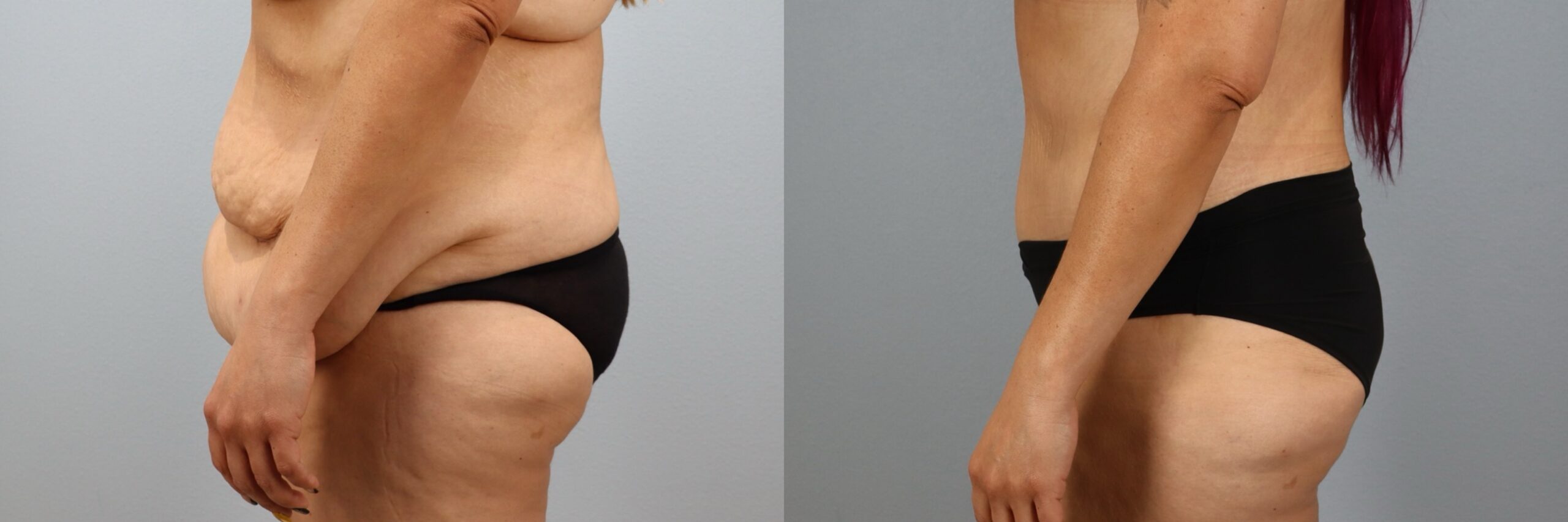 Before and after – Tummy Tuck – Female patient, age 40-49 – Image 18