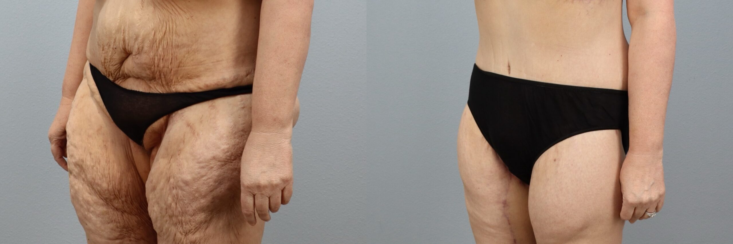 Before and after – Body Lift – Female patient, age 50-59 – Image 44