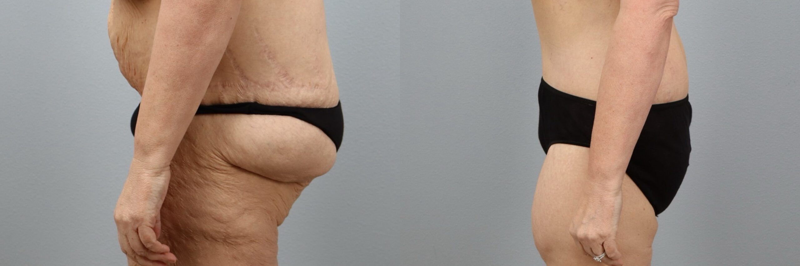 Before and after – Body Lift – Female patient, age 50-59 – Image 45