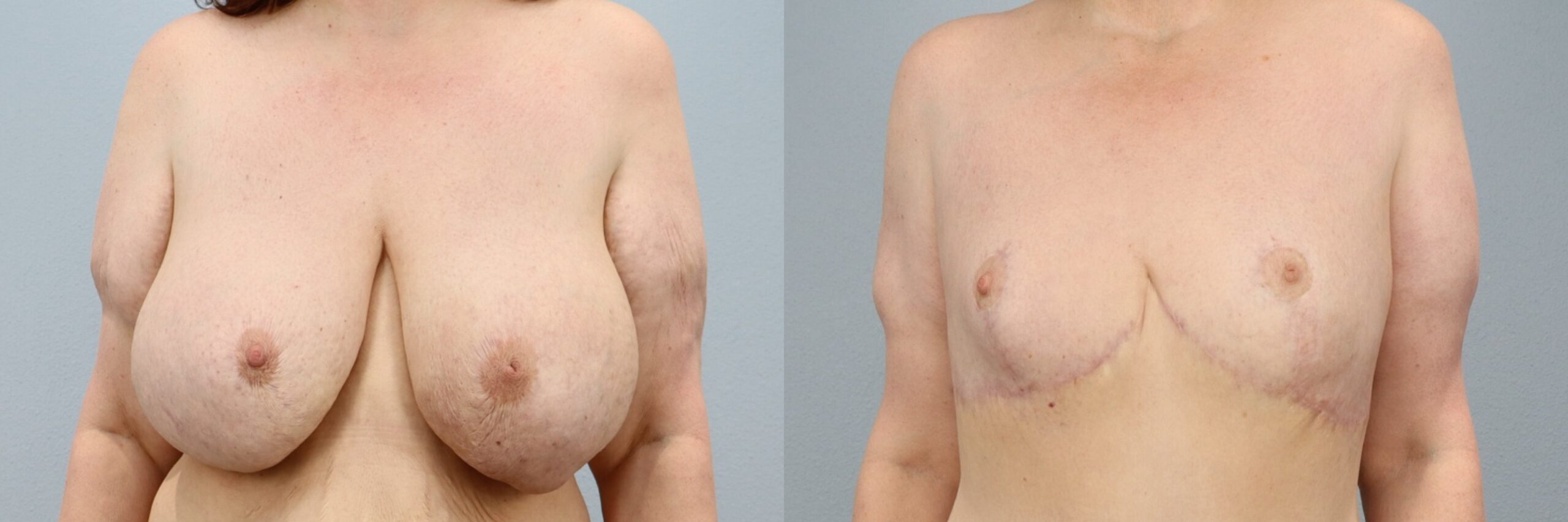 Before and after – Implant Removal – Female patient, age 50-59 – Image 8