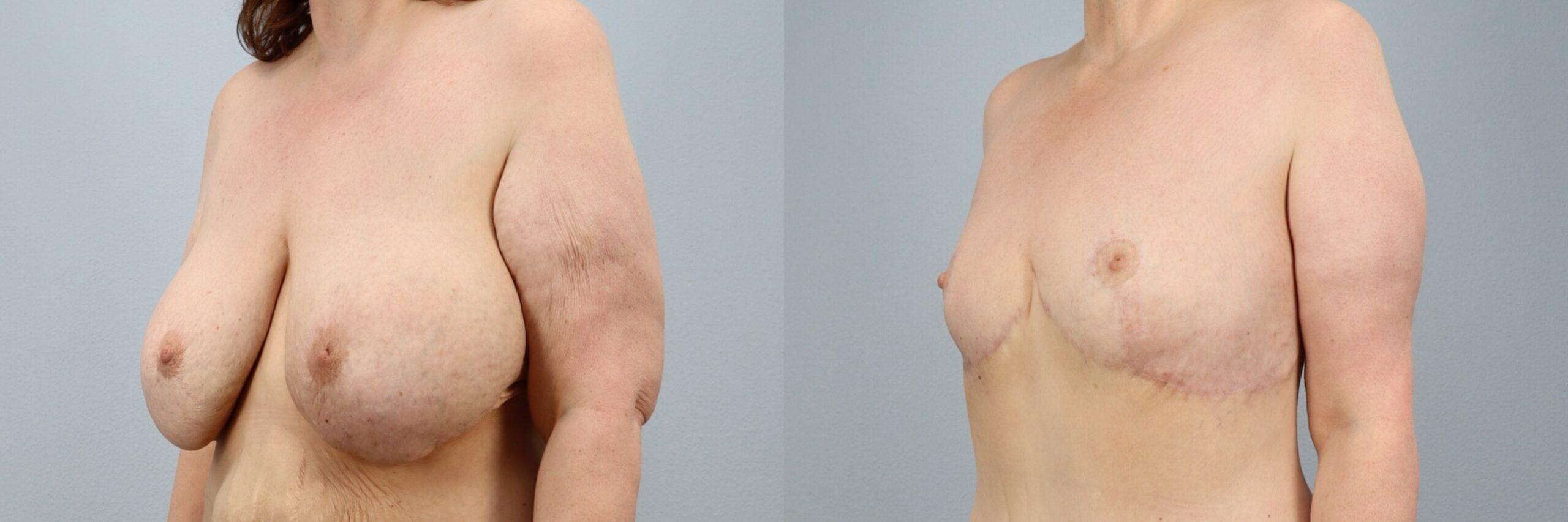 Before and after – Implant Removal – Female patient, age 50-59 – Image 9
