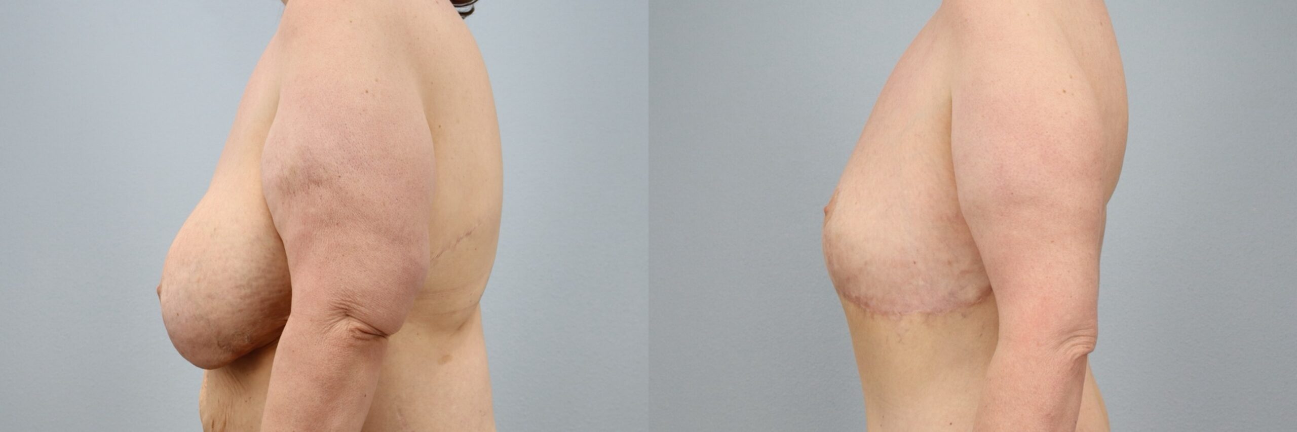 Before and after – Implant Removal – Female patient, age 50-59 – Image 10