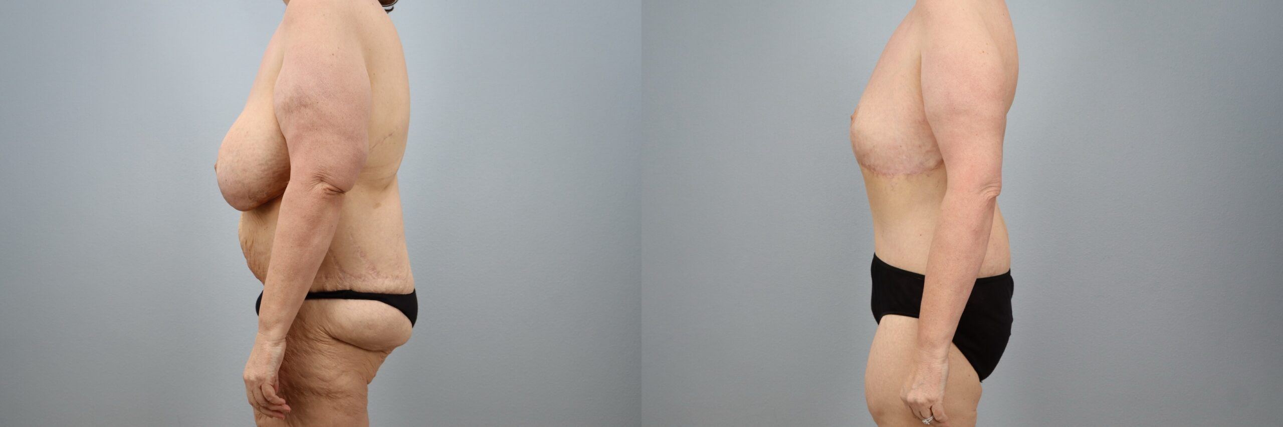 Before and after – Mommy Makeover – Female patient, age 50-59 – Image 54