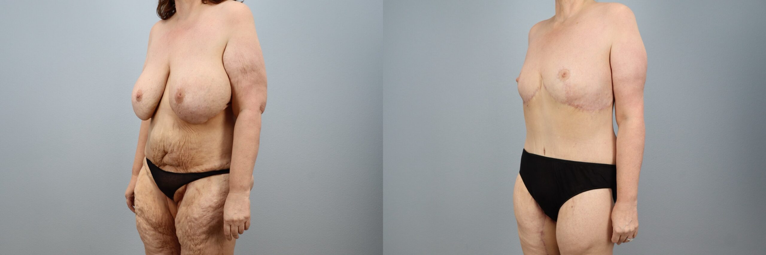 Before and after – Mommy Makeover – Female patient, age 50-59 – Image 56