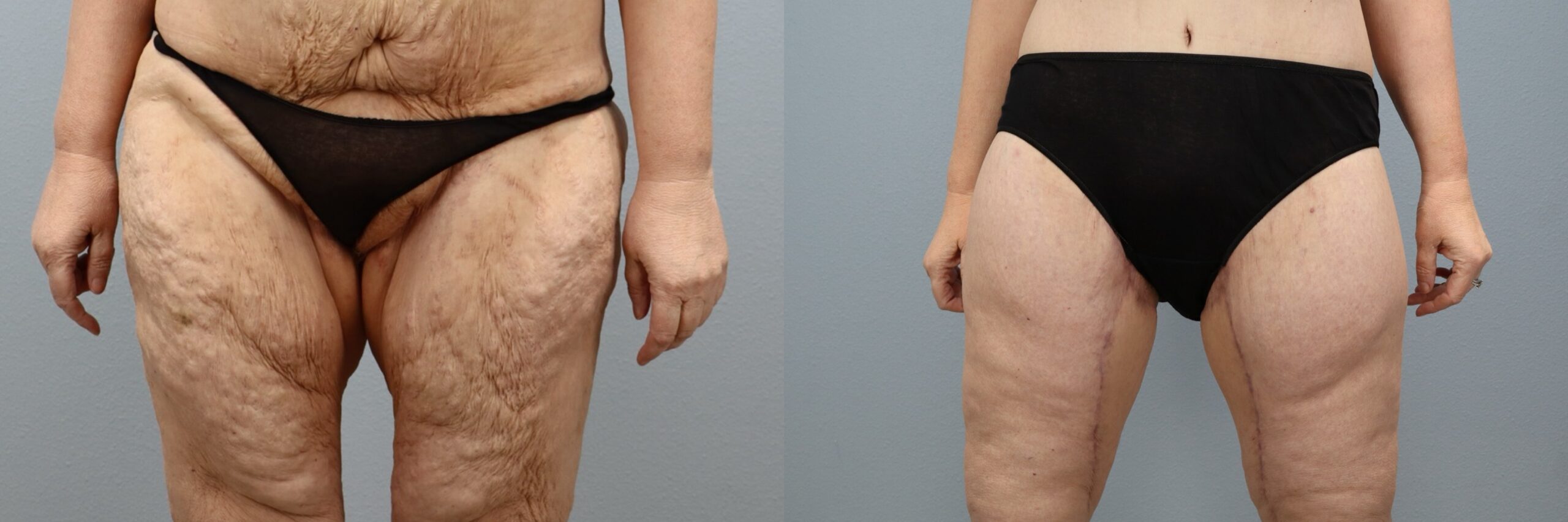 Before and after – Thigh Lift – Female patient, age 50-59 – Image 30
