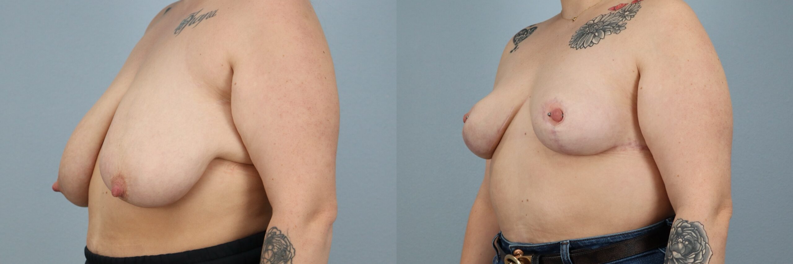 Before and after – Breast Reduction – Female patient, age 20-29 – Image 29