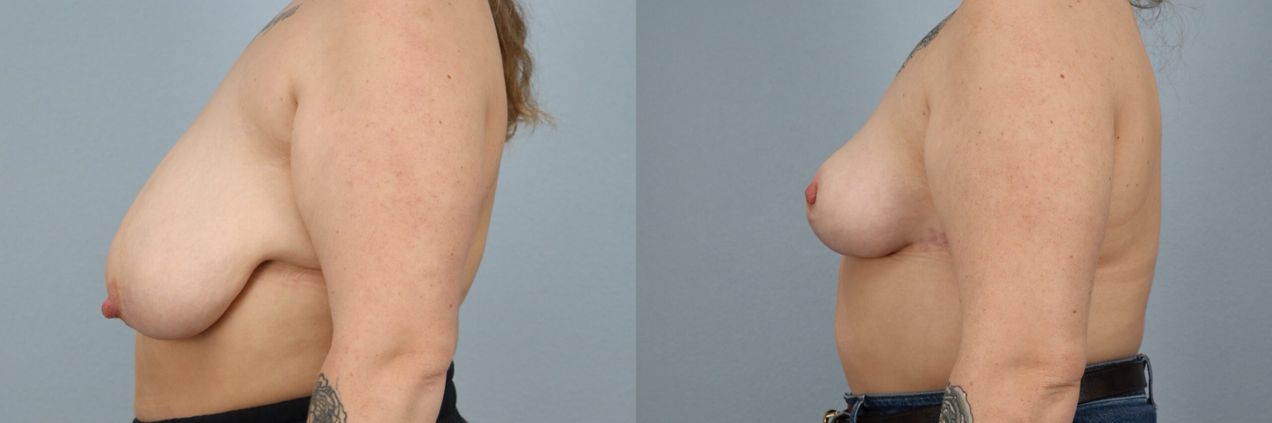 Before and after – Breast Reduction – Female patient, age 20-29 – Image 30