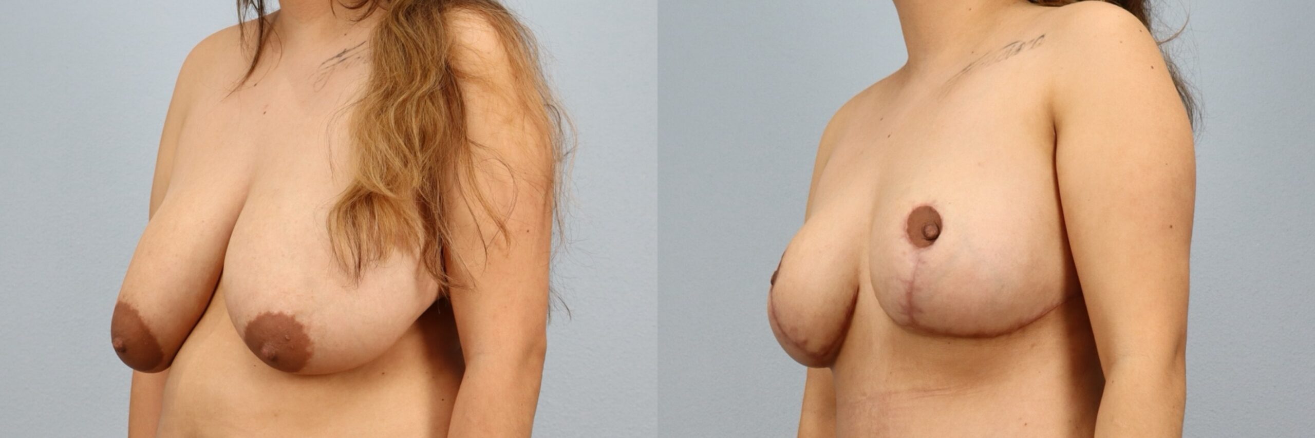 Before and after – Breast Reduction – Female patient, age 30-39 – Image 38