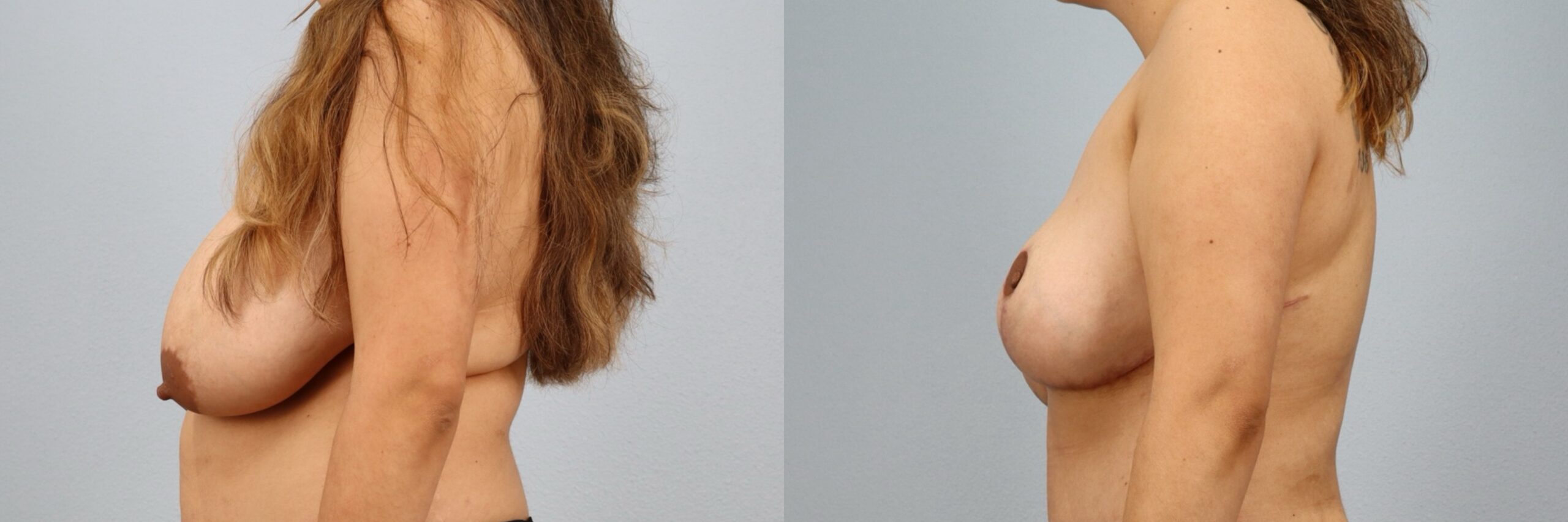 Before and after – Breast Reduction – Female patient, age 30-39 – Image 39