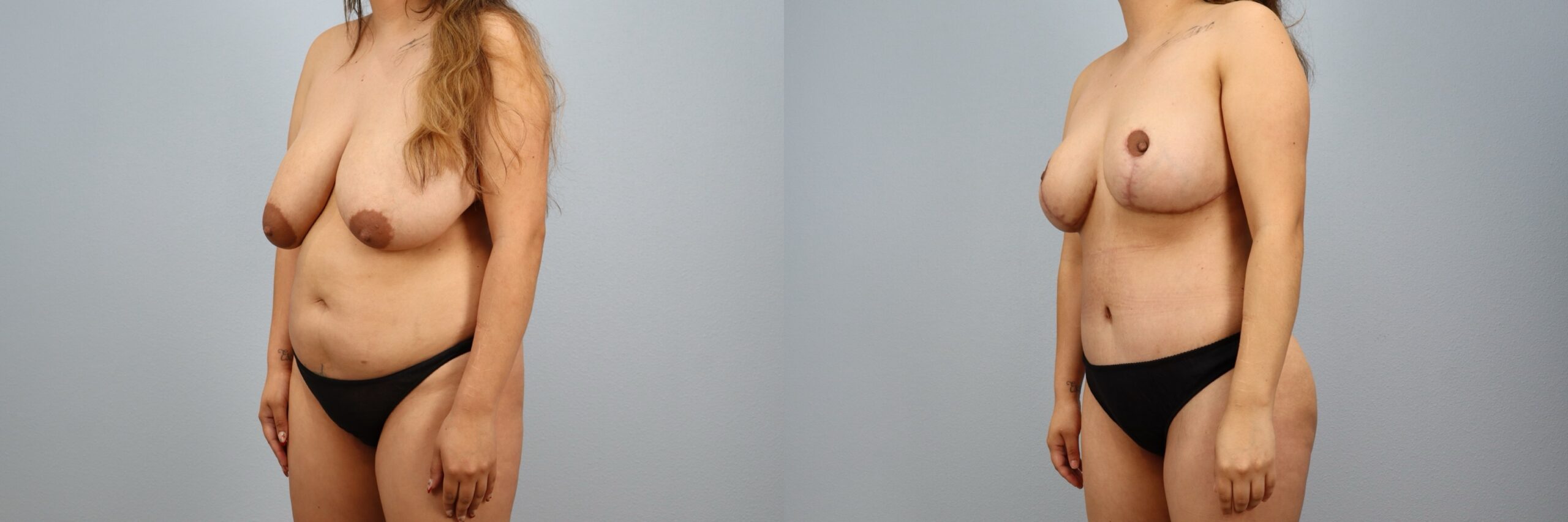 Before and after – Mommy Makeover – Female patient, age 30-39 – Image 50