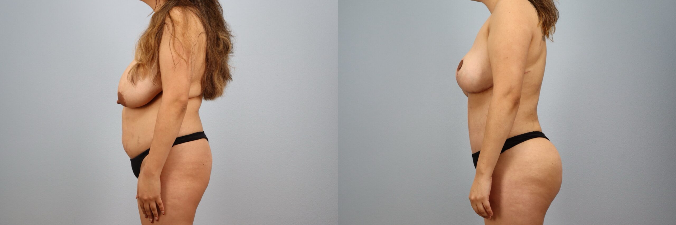 Before and after – Mommy Makeover – Female patient, age 30-39 – Image 51