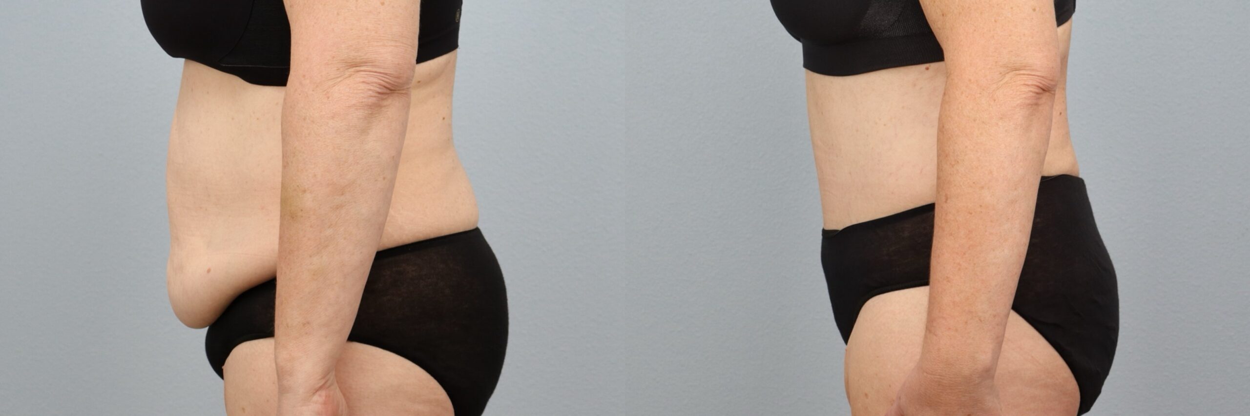 Before and after – Tummy Tuck – Female patient, age 50-59 – Image 36