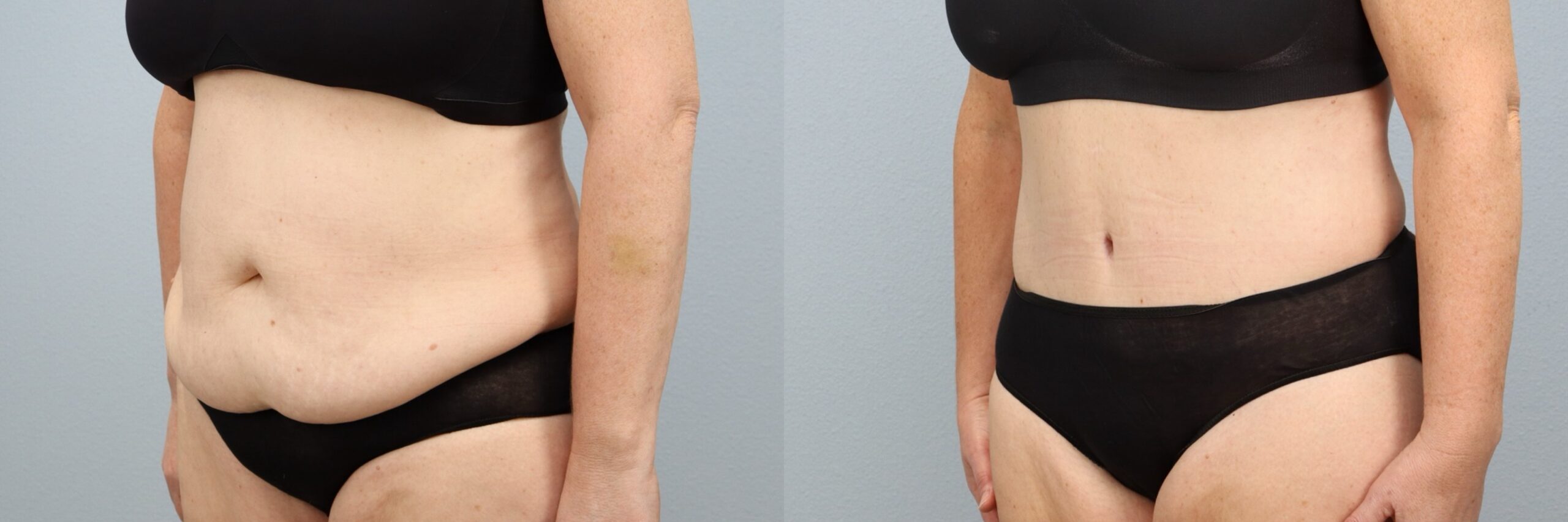 Before and after – Tummy Tuck – Female patient, age 50-59 – Image 35