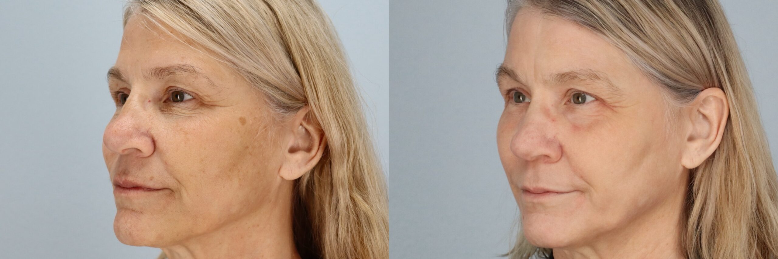 Before and after – Laser Resurfacing – Female patient, age 50-59 – Image 5