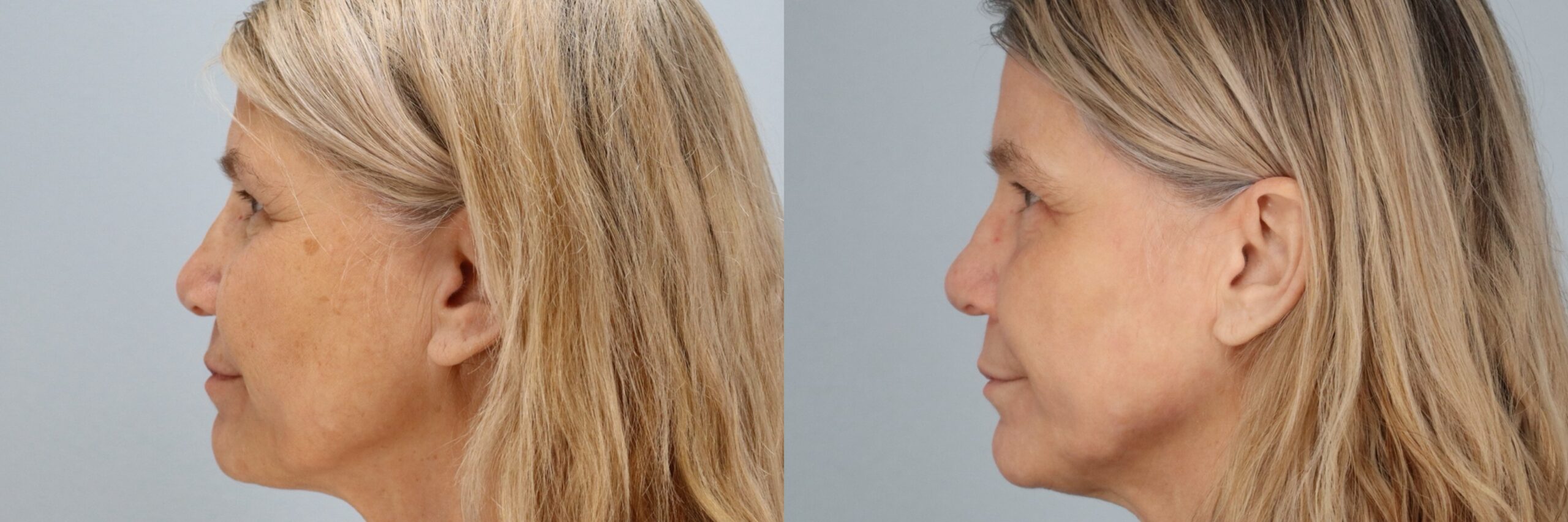 Before and after – Laser Resurfacing – Female patient, age 50-59 – Image 6