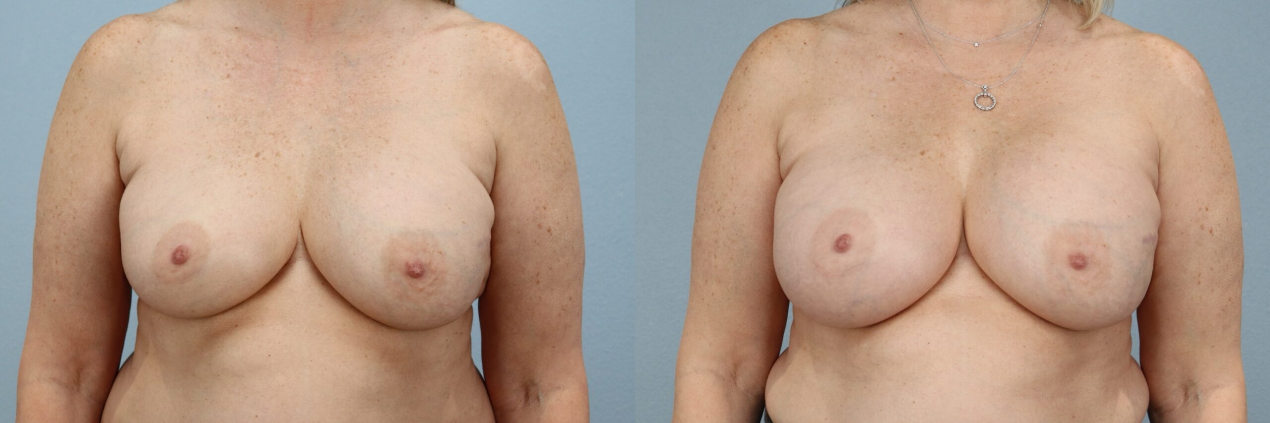 Before and after – Breast Revision – Female patient, age 50-59 – Image 31
