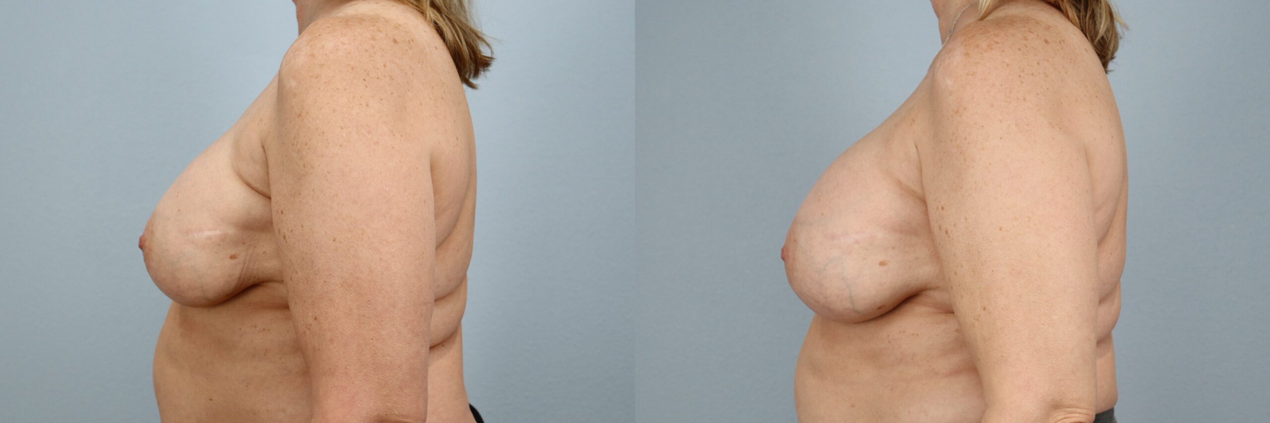 Before and after – Breast Revision – Female patient, age 50-59 – Image 33