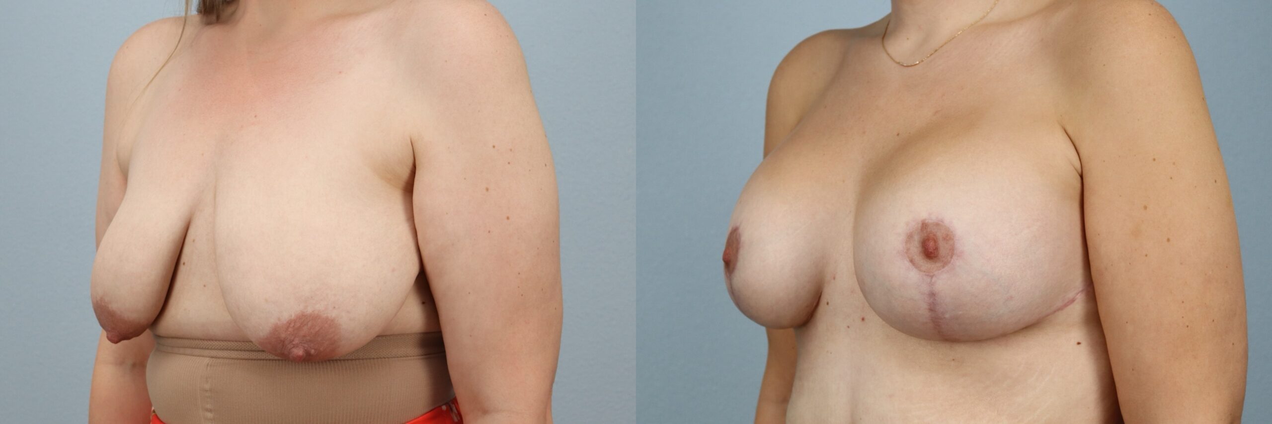 Before and after – Breast Lift With Implants – Female patient, age 30-39 – Image 47