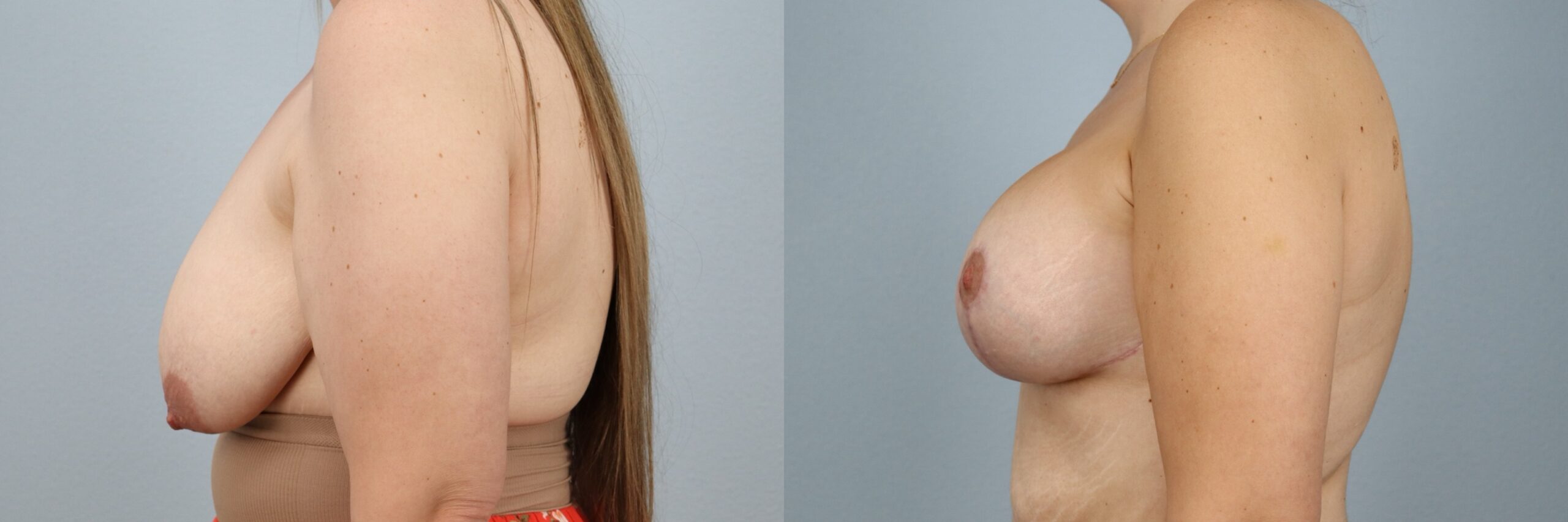 Before and after – Breast Lift With Implants – Female patient, age 30-39 – Image 48