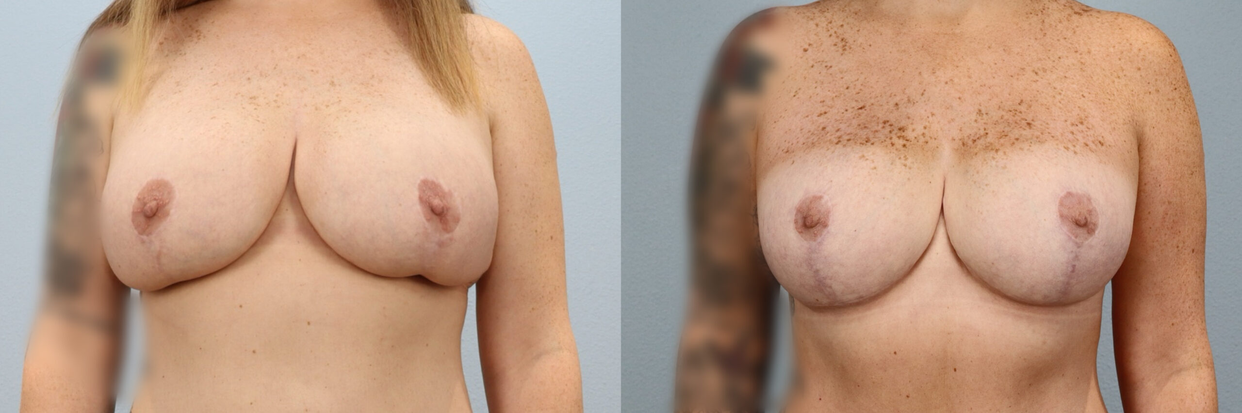 Before and after – Breast Revision – Female patient, age 30-39 – Image 31