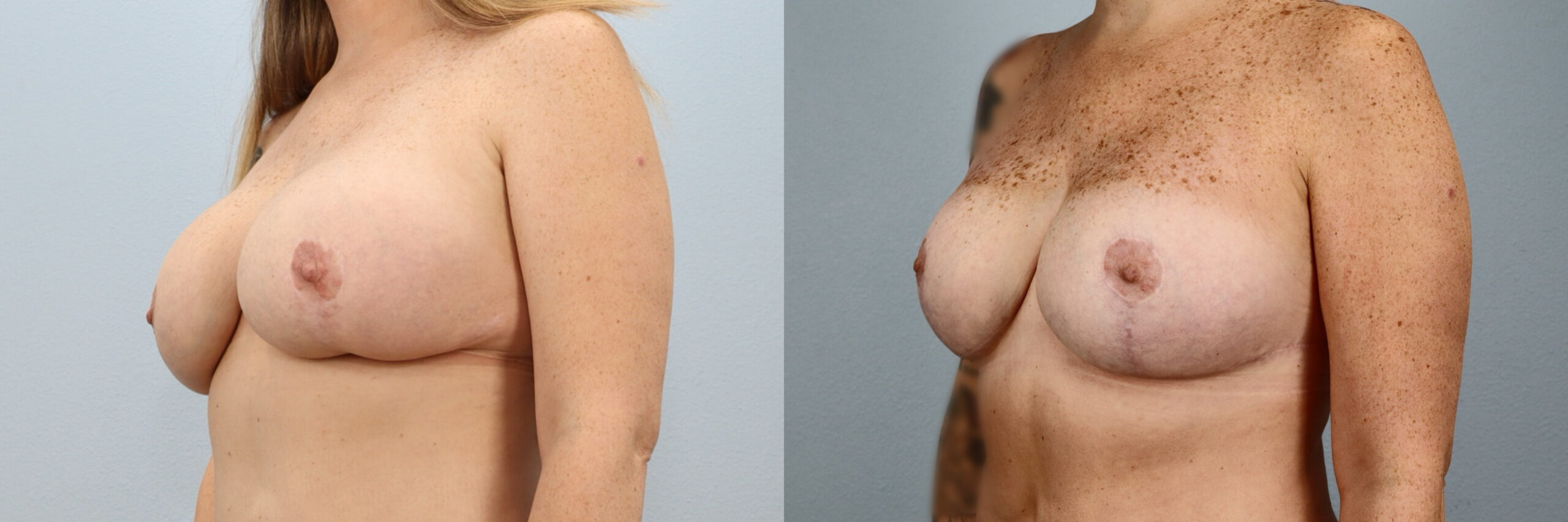 Before and after – Breast Revision – Female patient, age 30-39 – Image 32