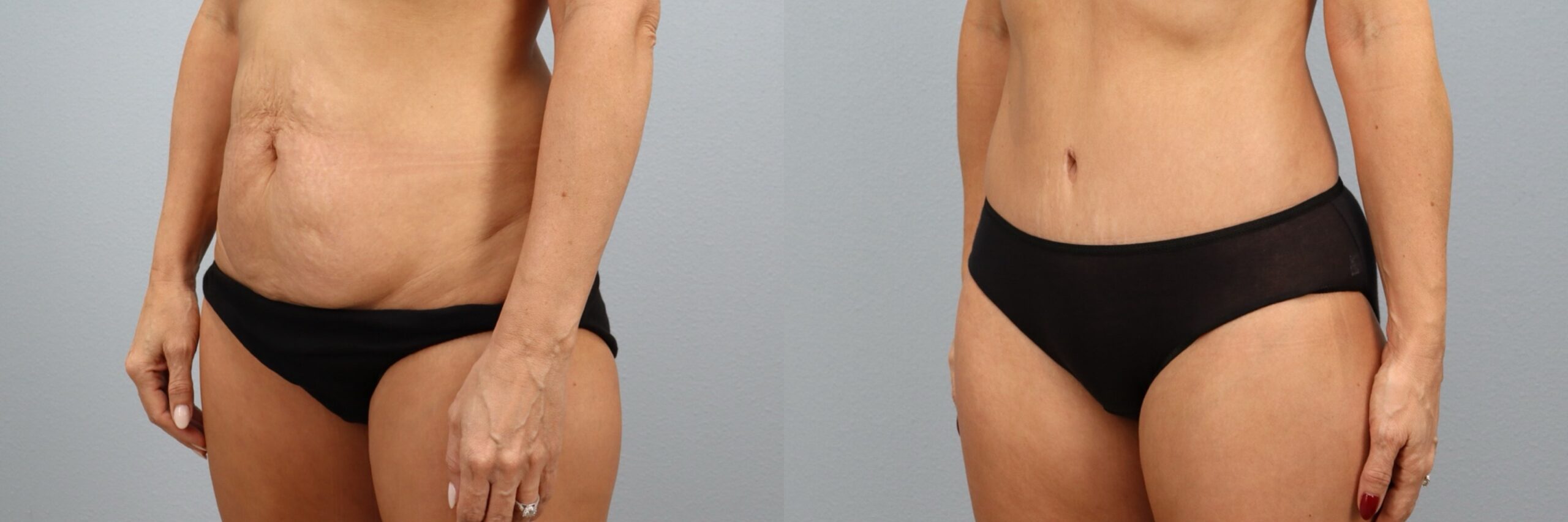 Before and after – Tummy Tuck – Female patient, age 40-49 – Image 14