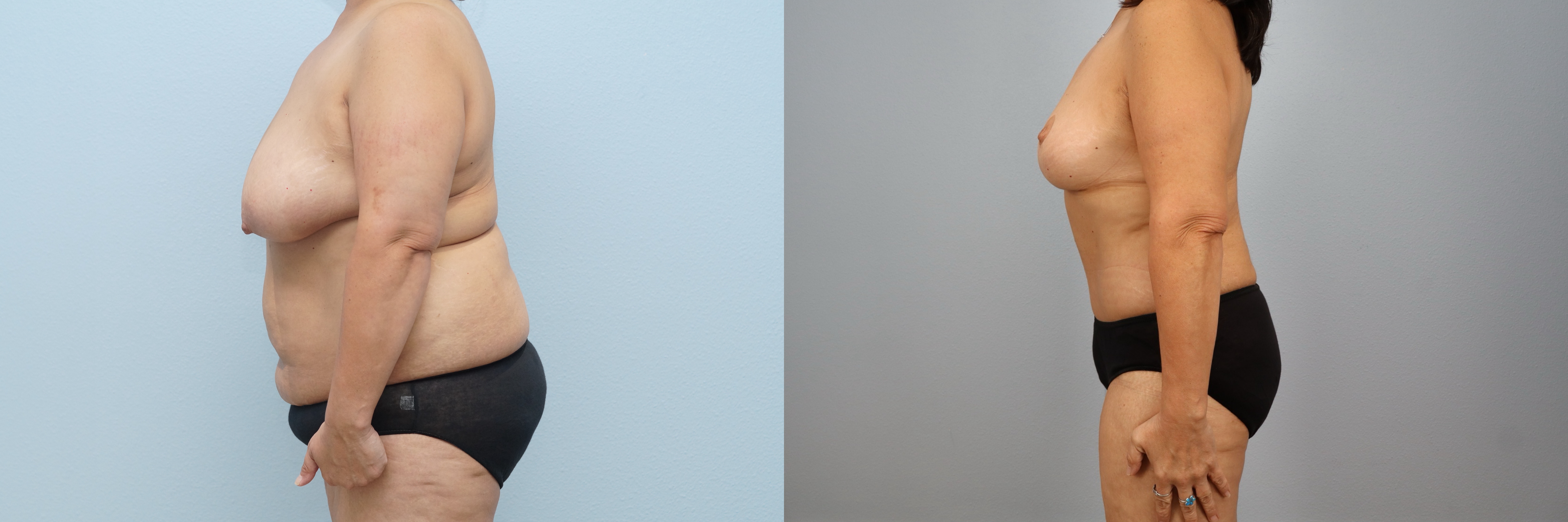 Before and after – Mommy Makeover – Female patient, age 50-59 – Image 48