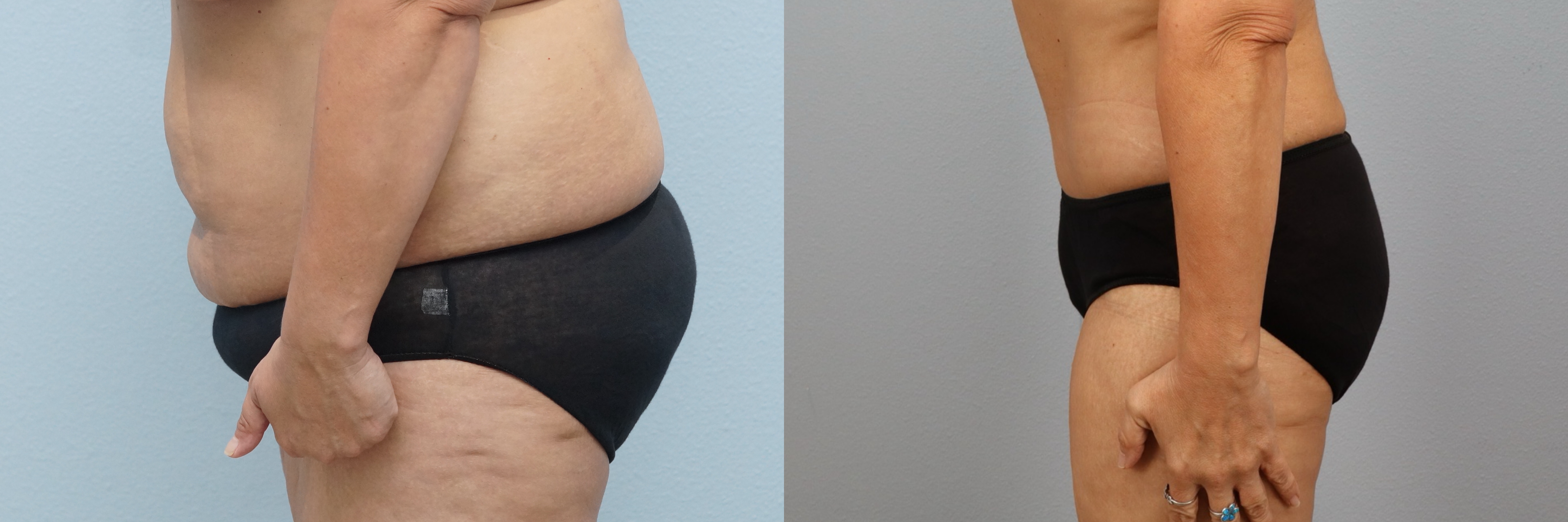 Before and after – Tummy Tuck – Female patient, age 50-59 – Image 12