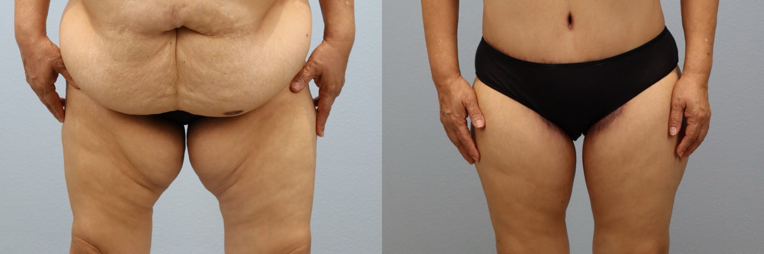 Before and after – Thigh Lift – Female patient, age 60+ – Image 38