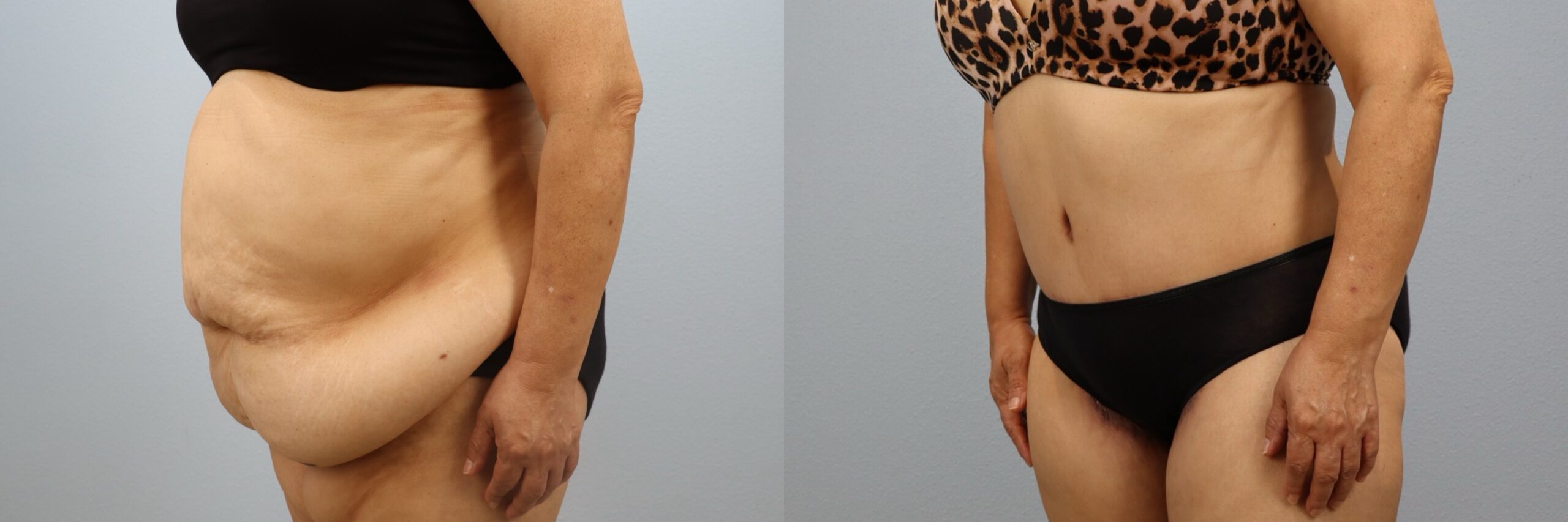 Before and after – Tummy Tuck – Female patient, age 60+ – Image 29