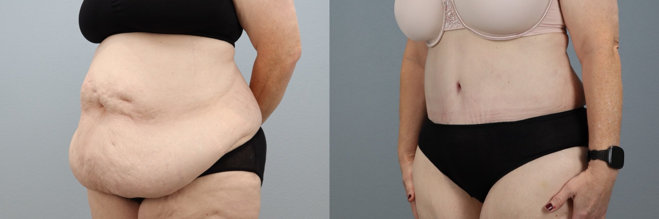 Before and after – Tummy Tuck – Female patient, age 60+ – Image 32