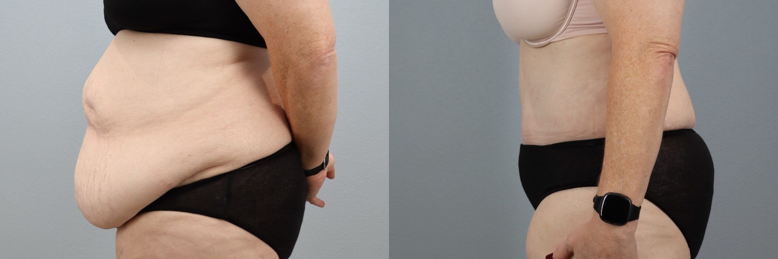 Before and after – Tummy Tuck – Female patient, age 60+ – Image 33