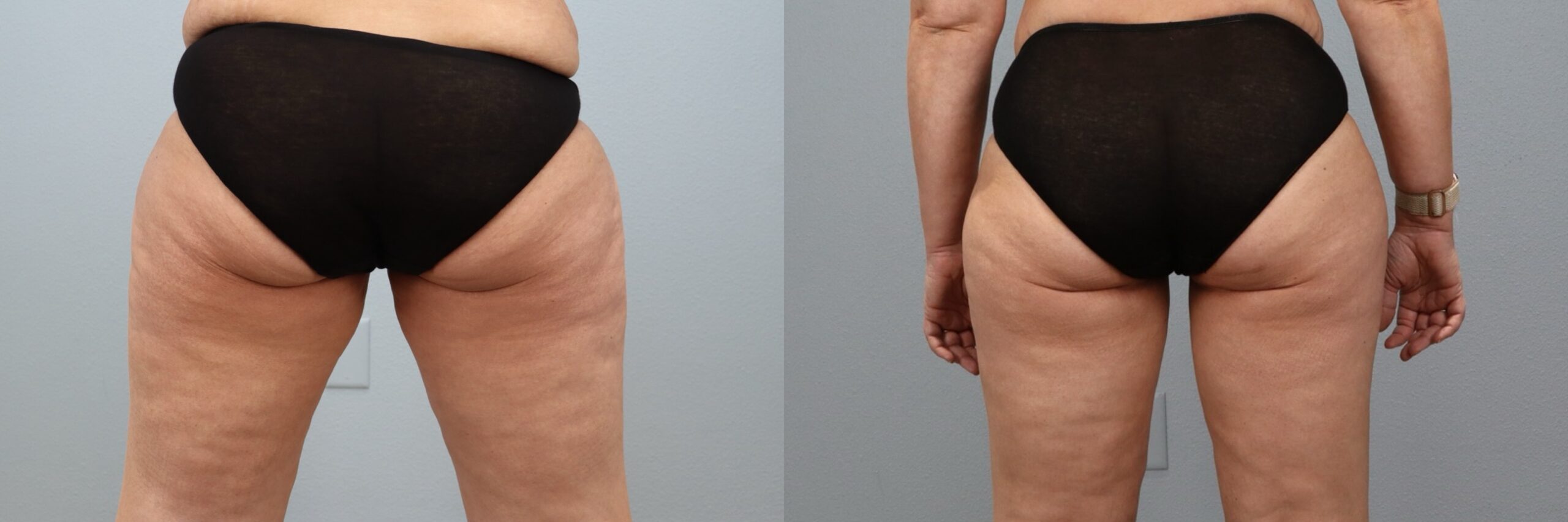 Before and after – Body Contouring – Female patient, age 40-49 – Image 40