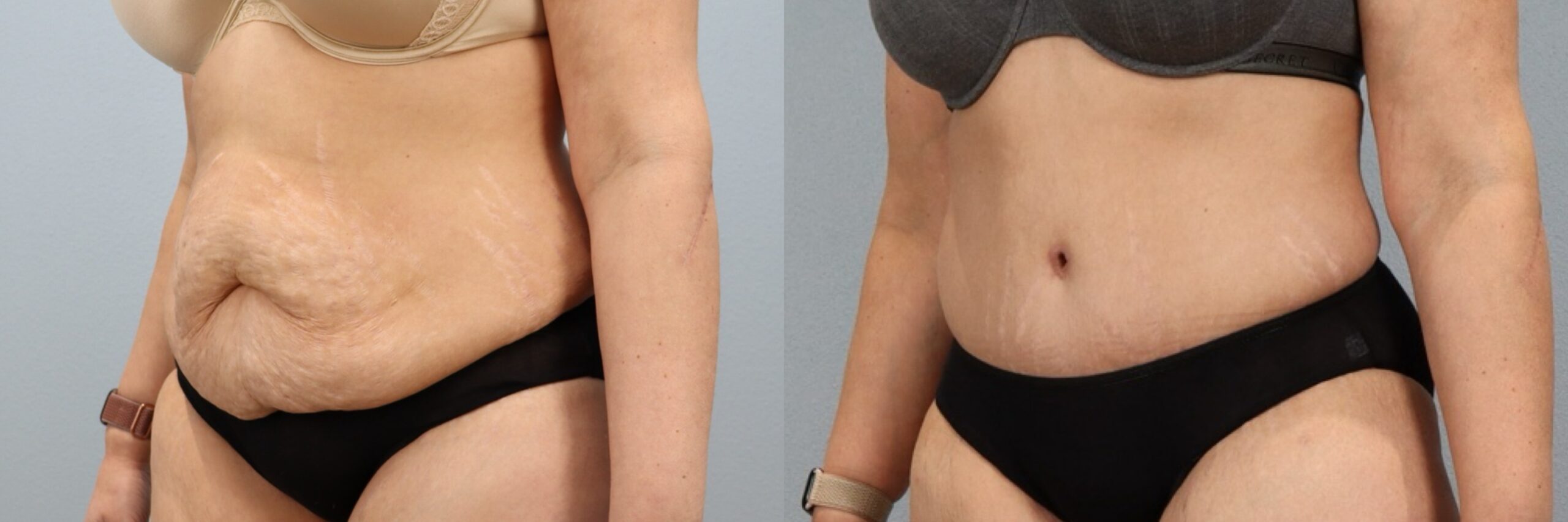 Before and after – Tummy Tuck – Female patient, age 40-49 – Image 5