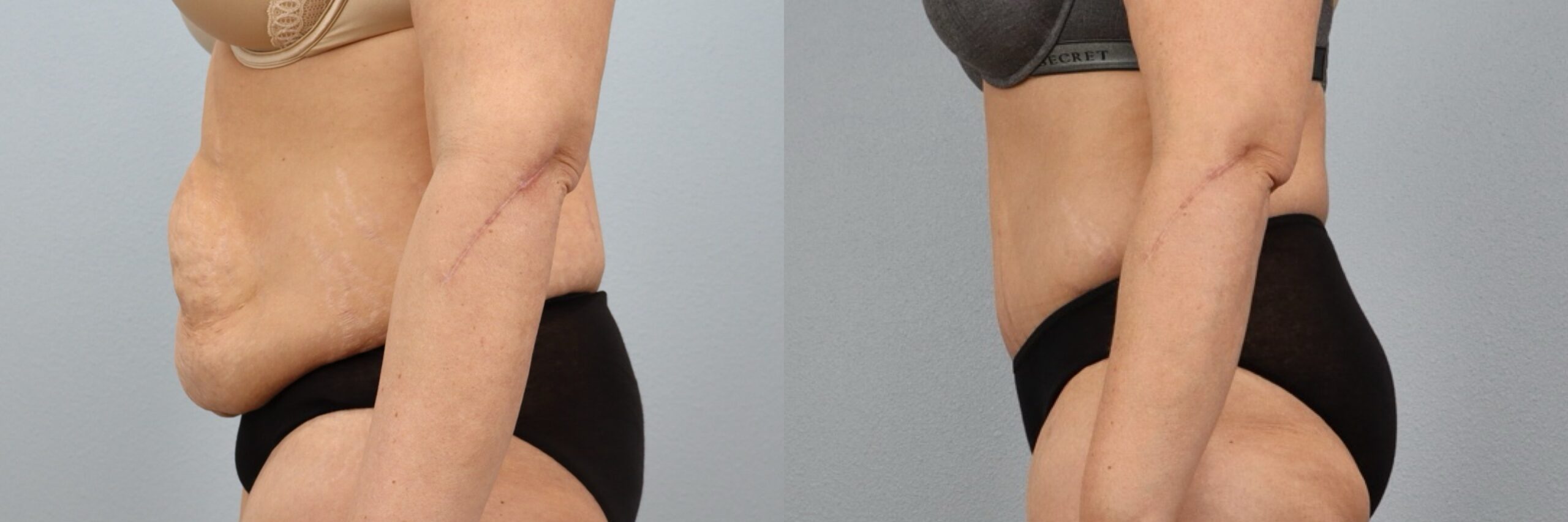 Before and after – Tummy Tuck – Female patient, age 40-49 – Image 6