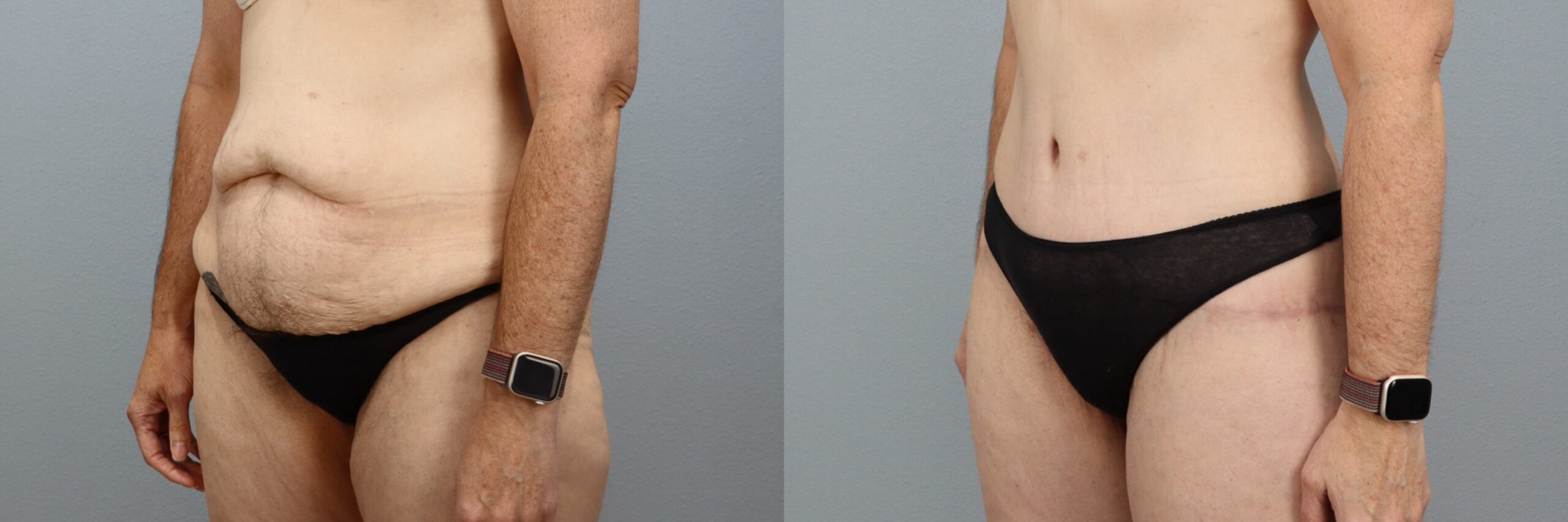 Before and after – Body Lift – Female patient, age 40-49 – Image 55