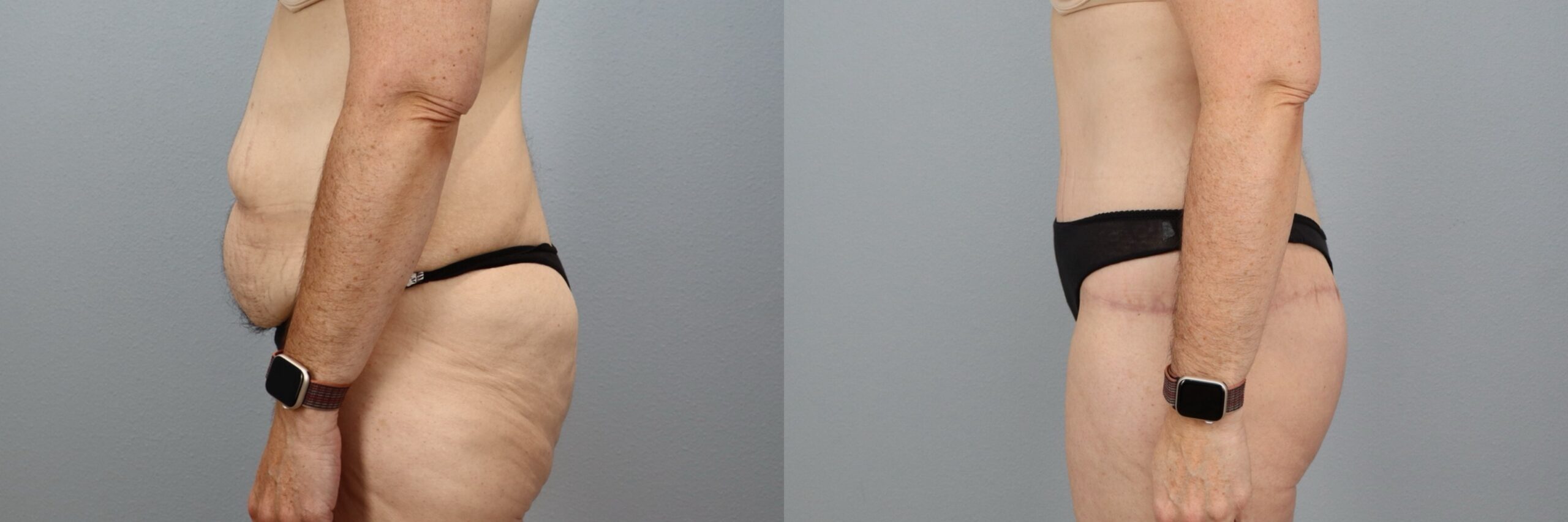 Before and after – Body Lift – Female patient, age 40-49 – Image 56