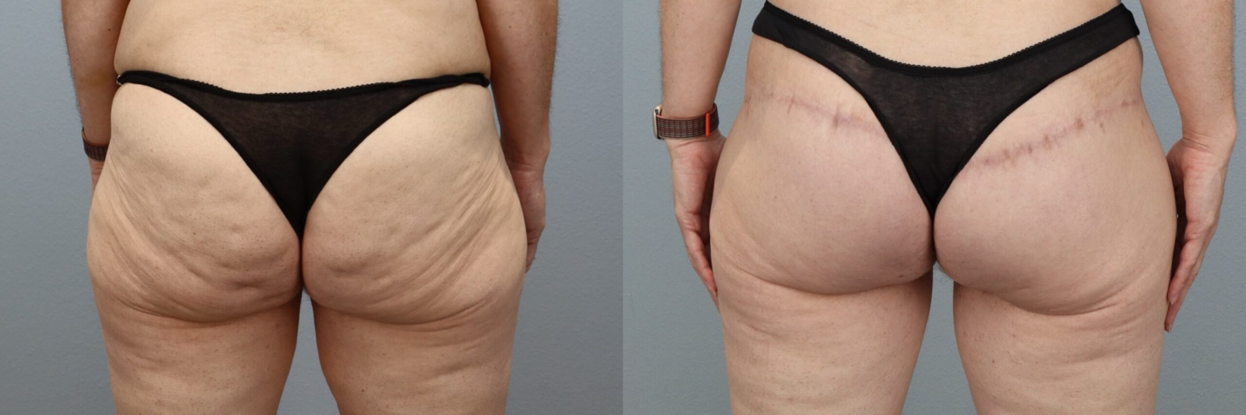 Before and after – Thigh Lift – Female patient, age 40-49 – Image 31