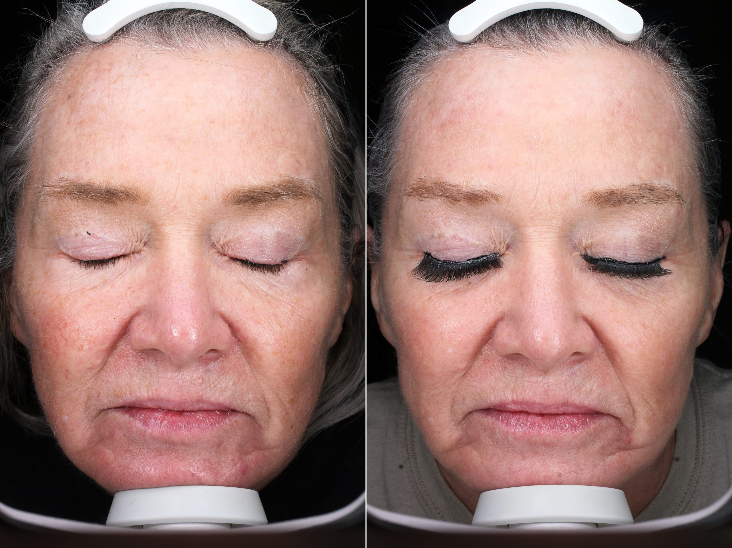 Before and after – Facial Lasers – Female patient, age 50-59 – Image 5