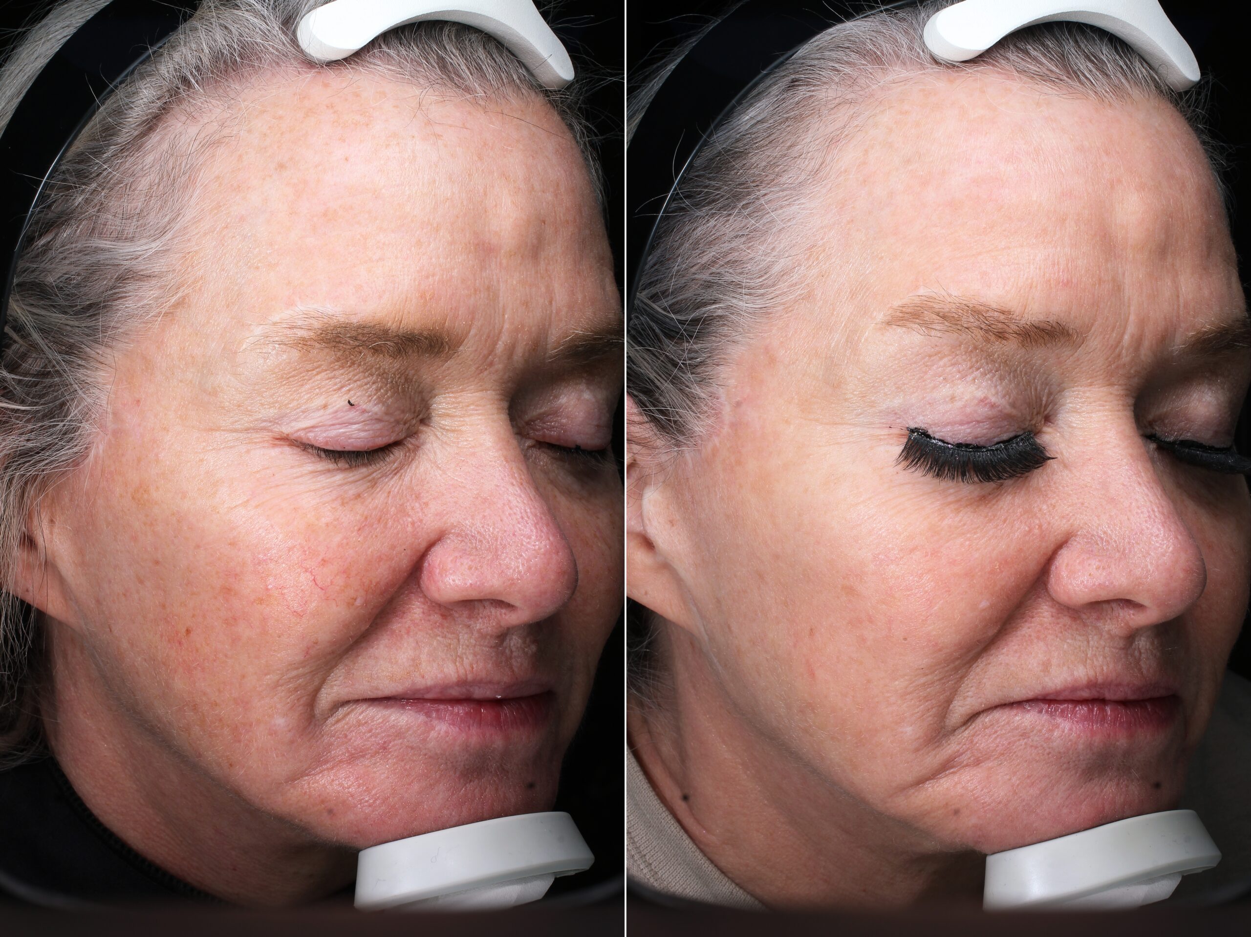 Before and after – Facial Lasers – Female patient, age 50-59 – Image 6