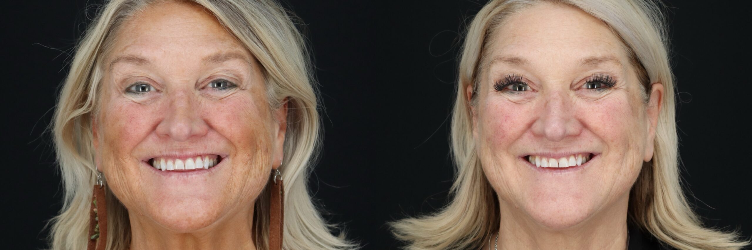 Before and after – Medi Spa – Female patient, age 60+ – Image 21
