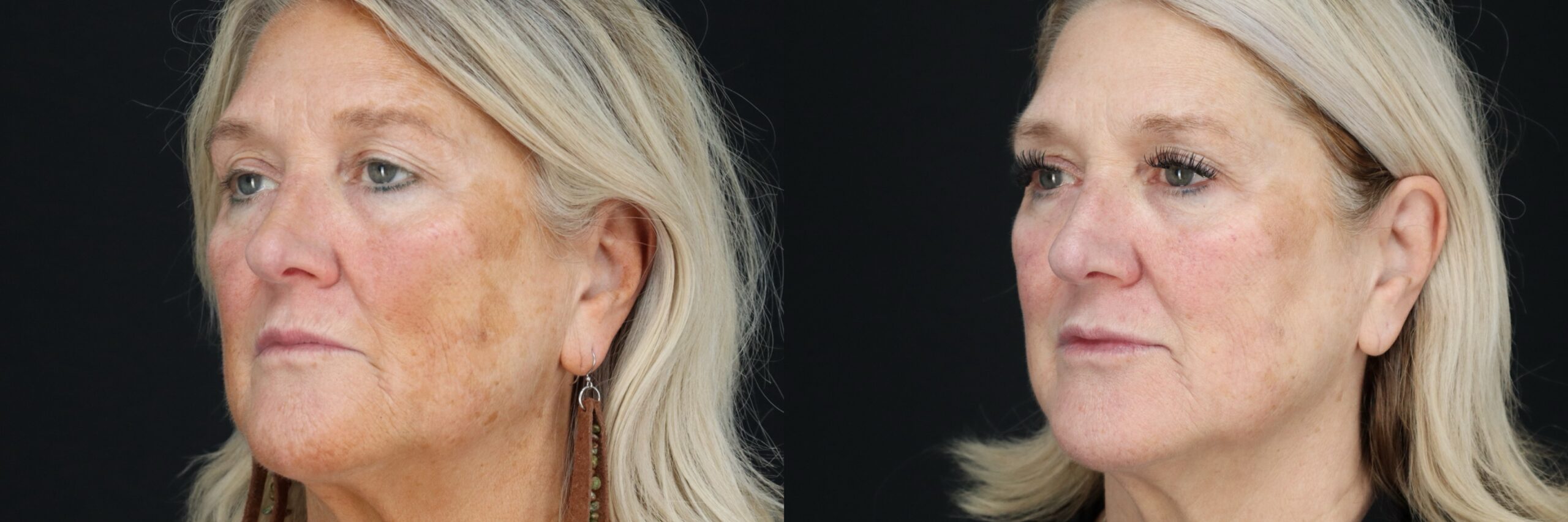 Before and after – Medi Spa – Female patient, age 60+ – Image 22