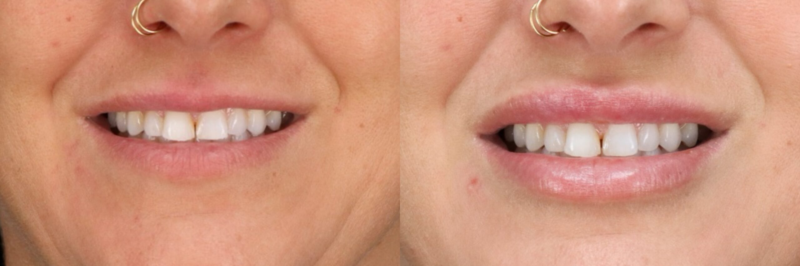 Before and after – Filler – Female patient, age 40-49 – Image 8