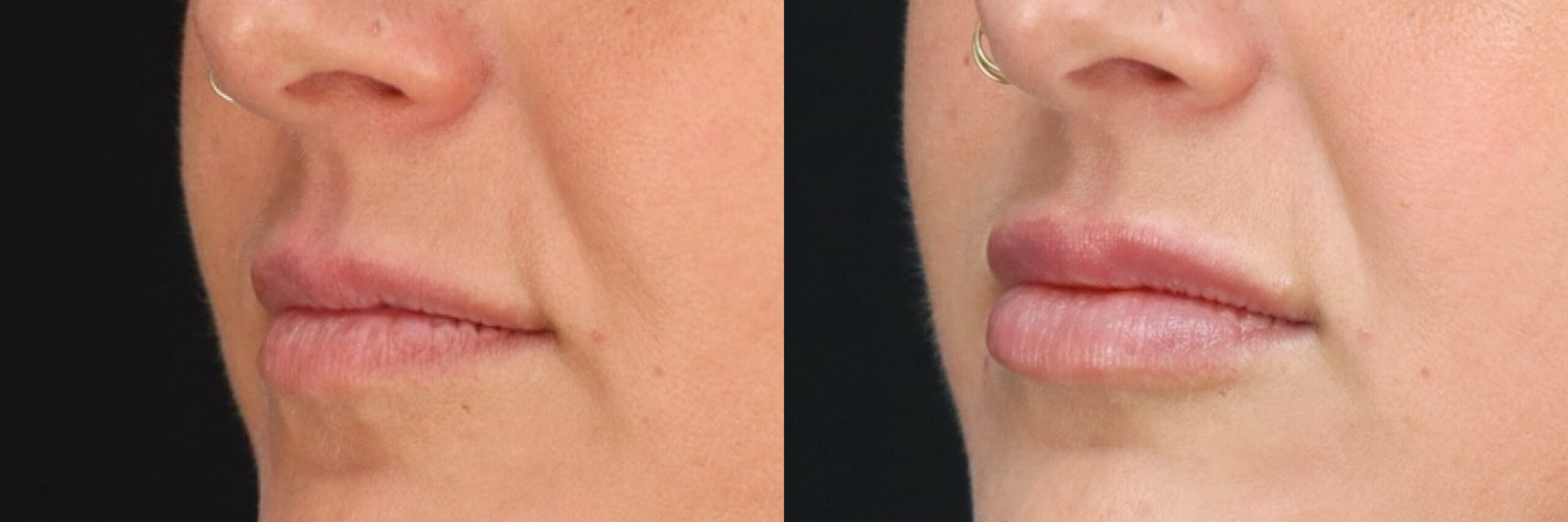 Before and after – Filler – Female patient, age 40-49 – Image 9