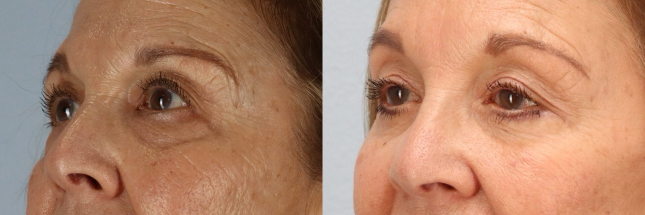 Before and after – Facial Surgery – Female patient, age 60+ – Image 41