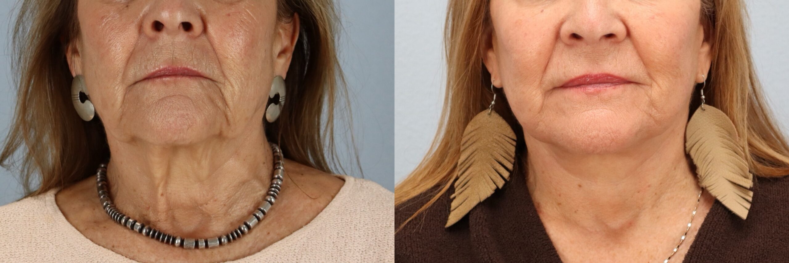 Before and after – Neck Lift – Female patient, age 60+ – Image 25