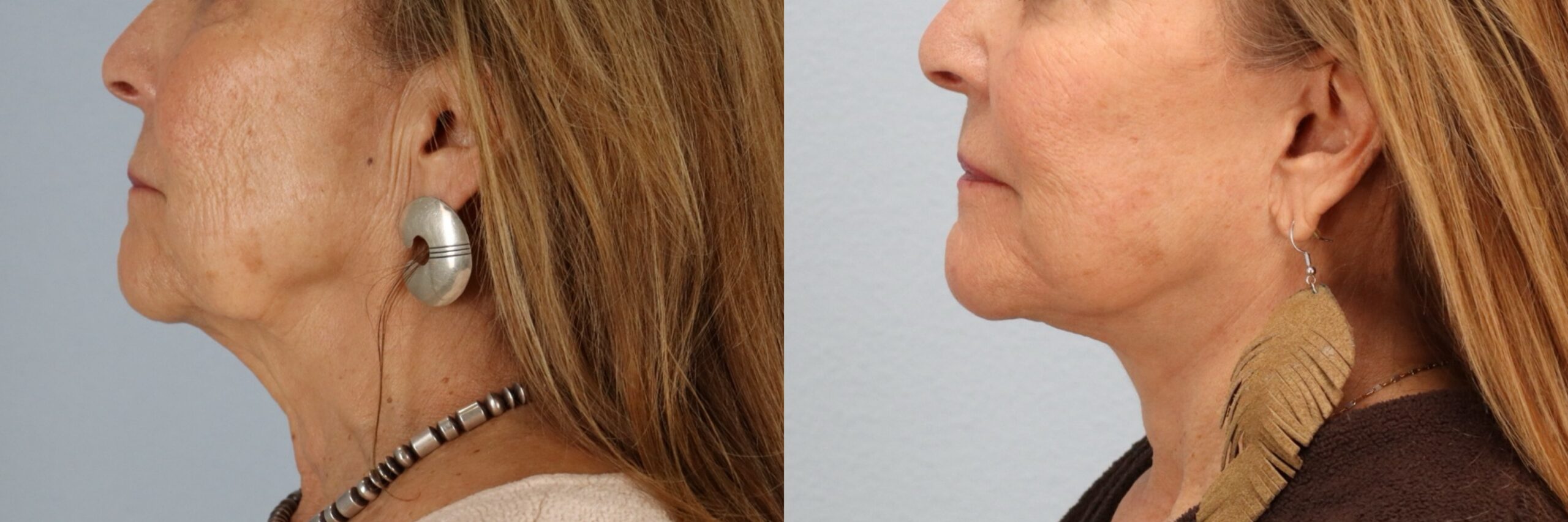 Before and after – Neck Lift – Female patient, age 60+ – Image 27