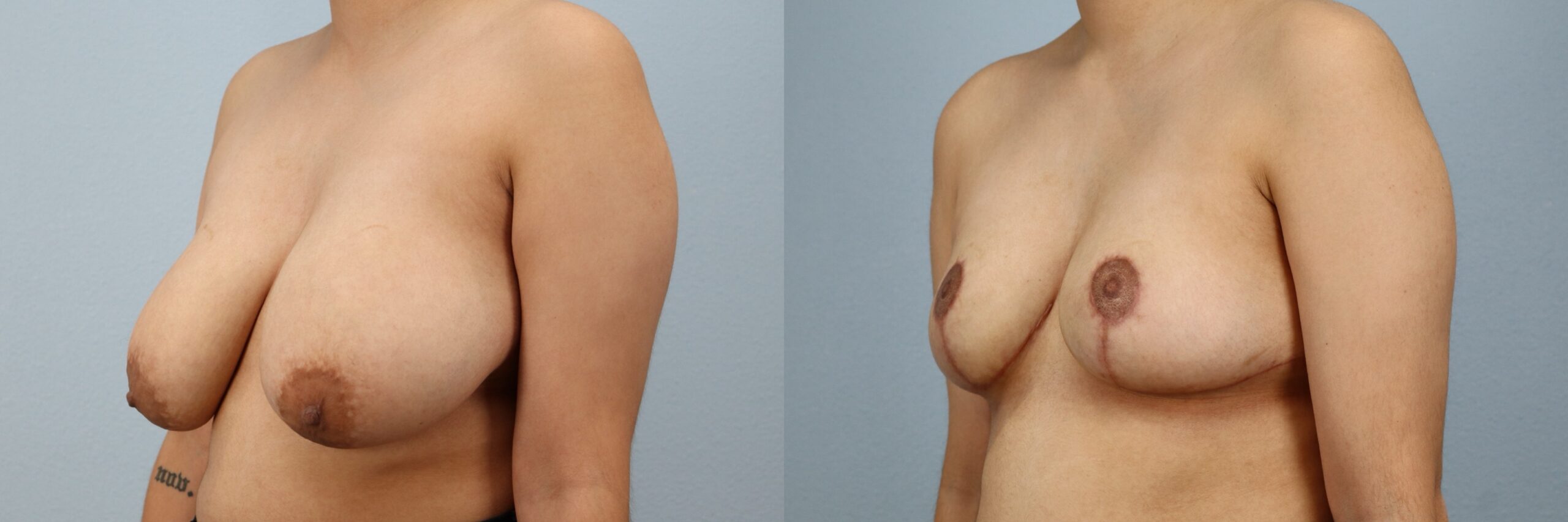Before and after – Breast Reduction – Female patient, age 20-29 – Image 47